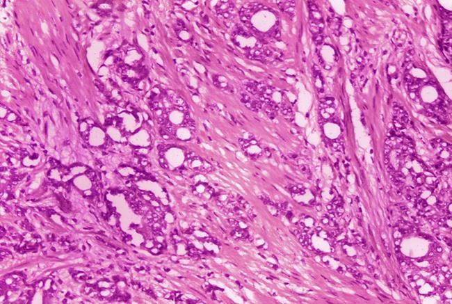 'Next big wave': Radiation drugs track and kill cancer cells | iNFOnews.ca CP926309421