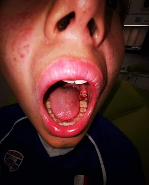 'Hurts so much:' Over 1,000 Nunavut children on wait-list for dental surgery | iNFOnews.ca