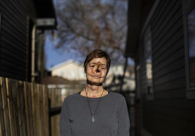 'I put life on hold:' Woman who had delayed surgery in Alberta says she's worse off | iNFOnews.ca