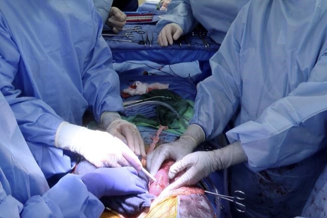 US researchers test pig-to-human transplant in donated body | iNFOnews.ca US researchers test pig-to-human transplant in donated body | iNFOnews.ca