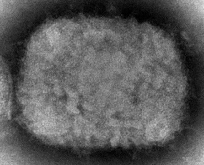 Canada considering smallpox vaccine for monkeypox cases, says Dr. Theresa Tam | iNFOnews.ca