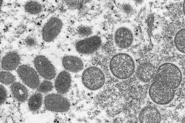 Israel reports first case of monkeypox, suspects others | iNFOnews.ca
