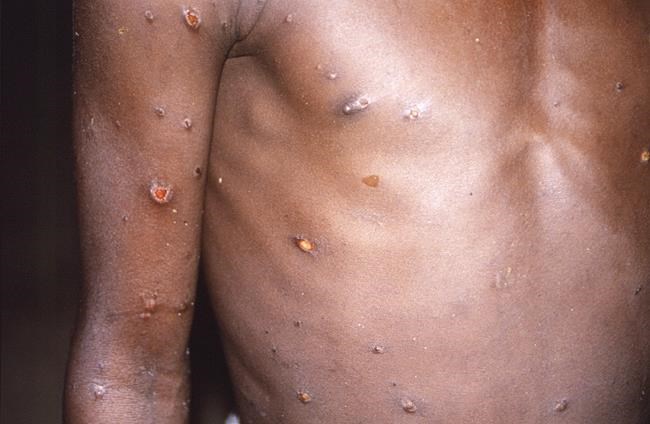 Africans see inequity in monkeypox response elsewhere | iNFOnews.ca