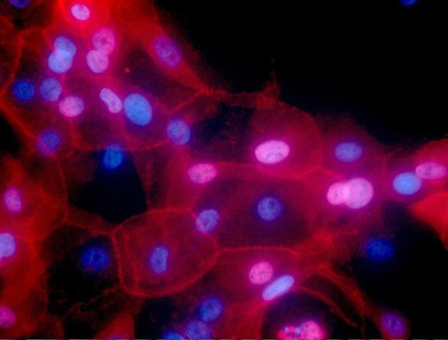 Some cancer patients can skip treatments, 2 studies show | iNFOnews.ca Some cancer patients can skip treatments, 2 studies show | iNFOnews.ca
