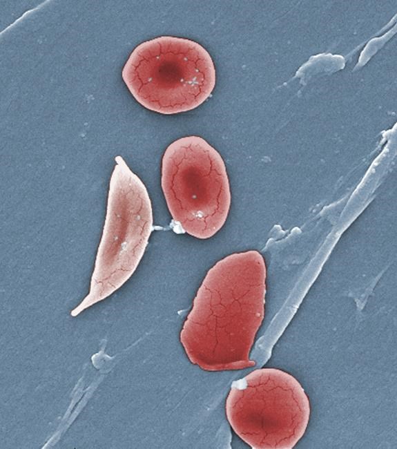 Study: Too few kids with sickle cell get stroke screen, care | iNFOnews.ca