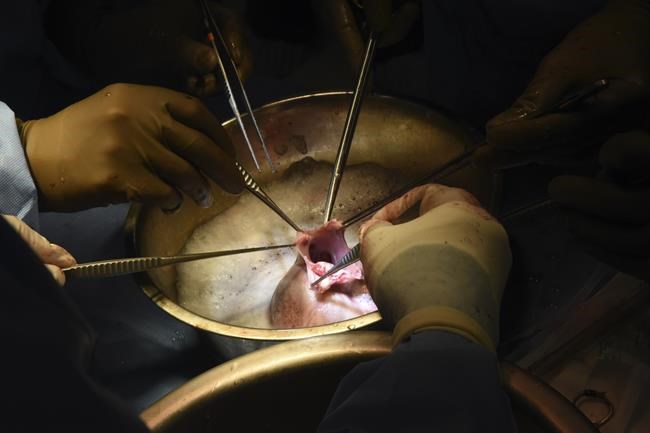 Surgeons perform second pig heart transplant, trying to save a dying man | iNFOnews.ca