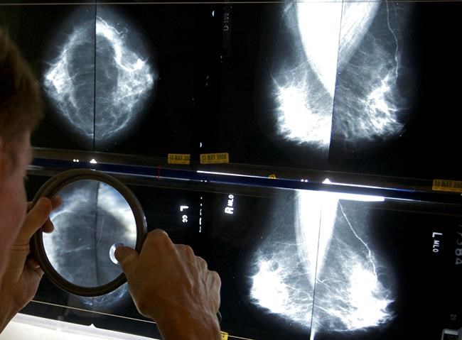 Breast cancer survivors may not need so many mammograms after surgery, UK study suggests | iNFOnews.ca