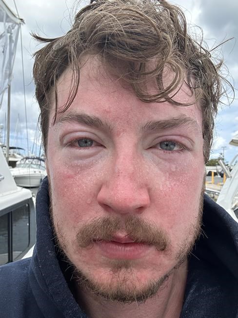 'Like a hot iron.' B.C. man's ultra-marathon Hawaiian swim is scuttled by jellyfish | iNFOnews.ca