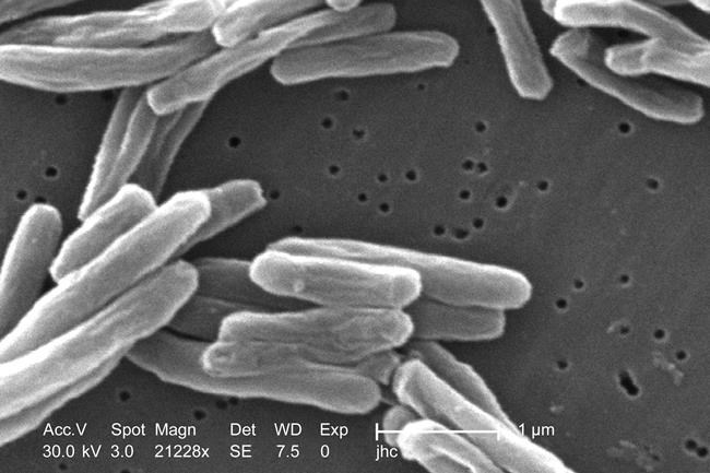 US tuberculosis cases were at the highest level in a decade in 2023 | iNFOnews.ca US tuberculosis cases were at the highest level in a decade in 2023 | iNFOnews.ca