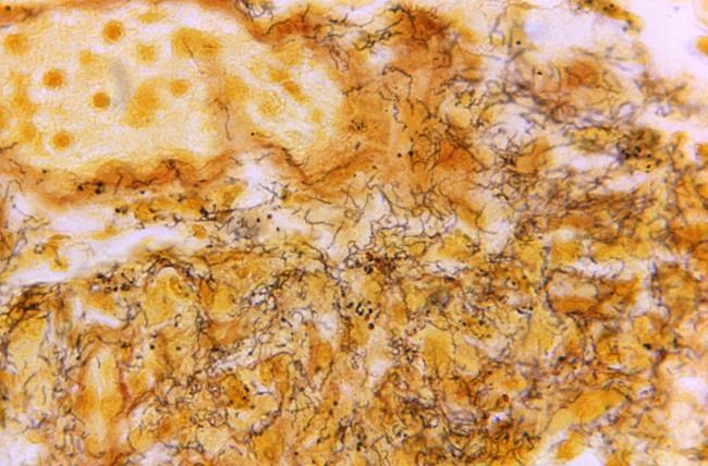 Montreal network to tackle 'explosion' in infections such as syphilis with new trials | iNFOnews.ca Montreal network to tackle 'explosion' in infections such as syphilis with new trials | iNFOnews.ca