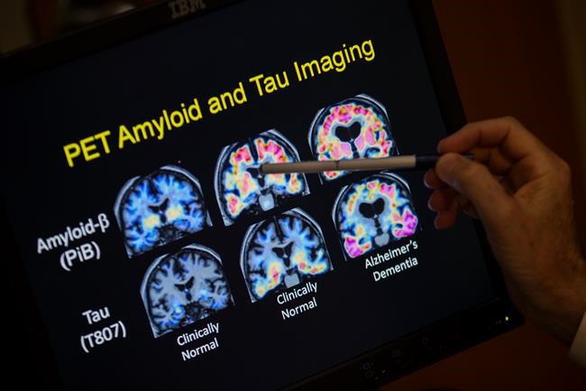 Blood tests for Alzheimer's may be coming to your doctor's office. Here's what to know | iNFOnews.ca