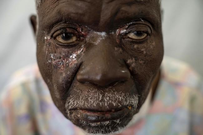 Africa has almost 4,000 new mpox cases in a week, but the wait for vaccines continues | iNFOnews.ca