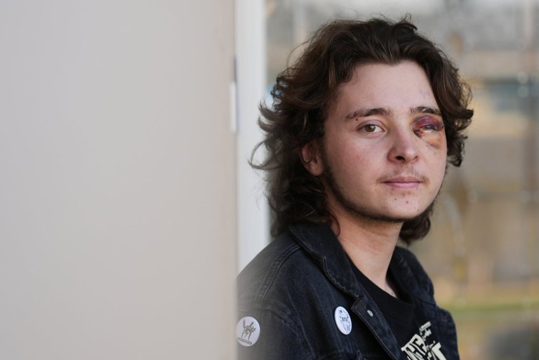 California protester left blind in one eye is among string of violent run-ins with federal agents | iNFOnews.ca