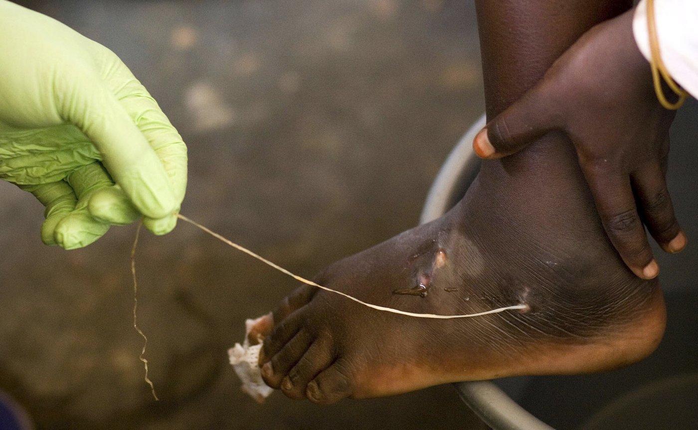 Jimmy Carter made eradicating Guinea worm disease a top mission | iNFOnews.ca