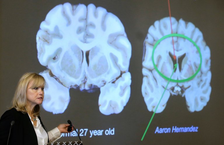 Here's what to know about CTE, the brain disease the NYC shooter blamed for his mental health issues | iNFOnews.ca