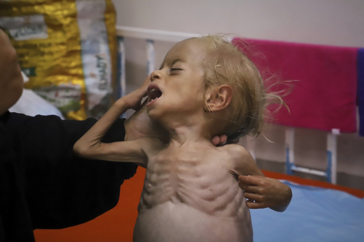 Malnourished kids arrive daily at a Gaza hospital as Netanyahu denies hunger | iNFOnews.ca