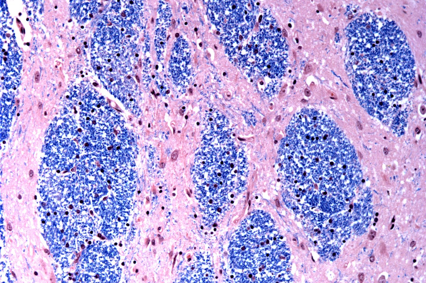 Surprise finding sheds light on what causes Huntington's disease, a devastating fatal brain disorder | iNFOnews.ca