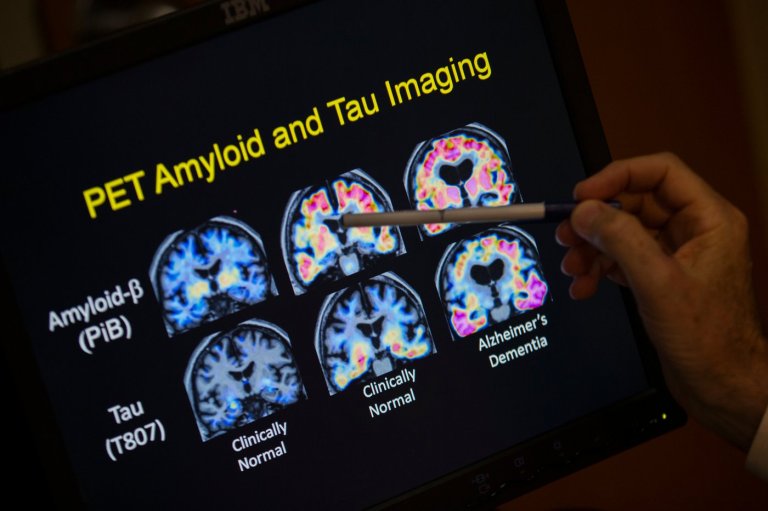 Want to lower your risk of dementia? It doesn't involve a blood test | iNFOnews.ca