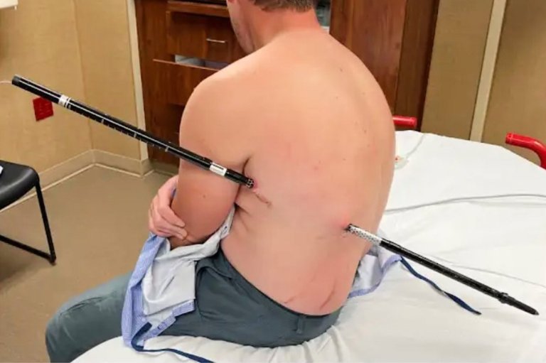 Montana man hikes out of the mountains to get help after he was impaled by a trekking pole | iNFOnews.ca
