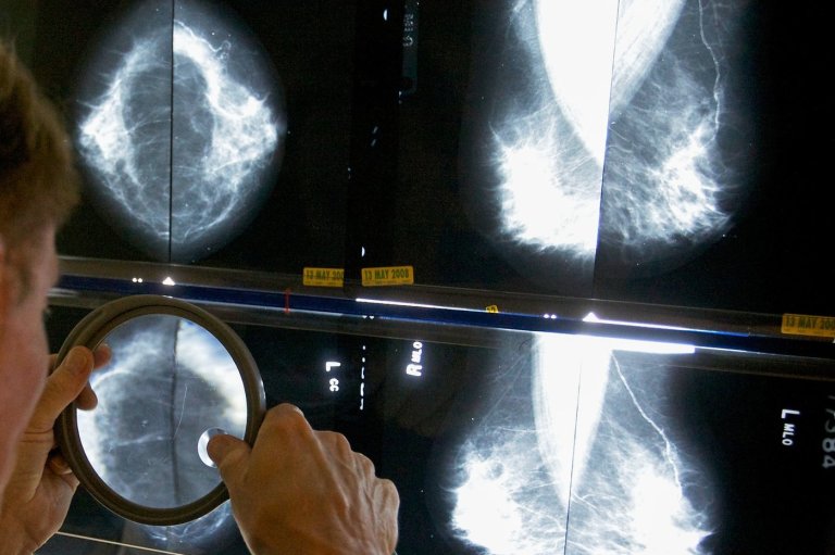 When should you get a mammogram? Conflicting advice makes it hard to know | iNFOnews.ca