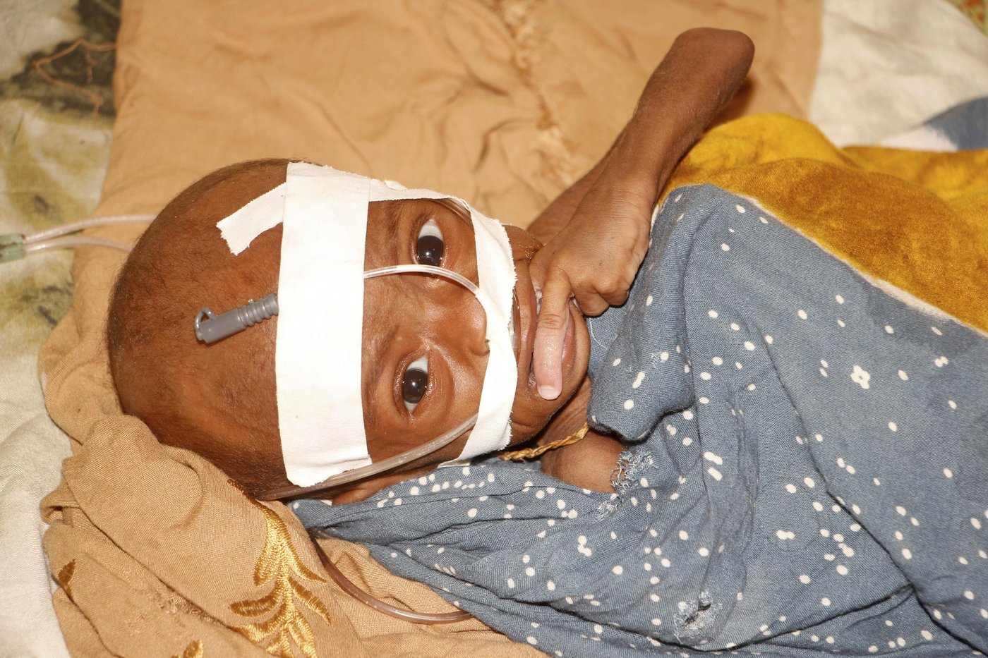 US aid kept many hungry Somali children alive. Now that money is disappearing | iNFOnews.ca