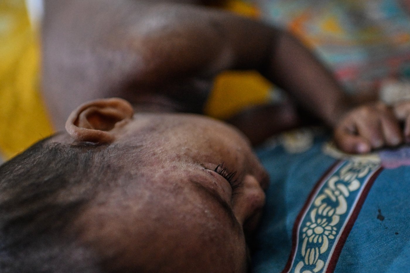 Suspected measles cases kill nearly 1,000 as Bangladesh struggles to contain outbreak | iNFOnews.ca
