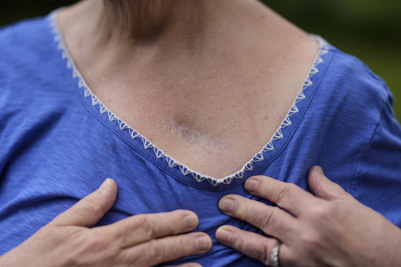 NIH cuts spotlight a hidden crisis facing patients with experimental brain implants | iNFOnews.ca