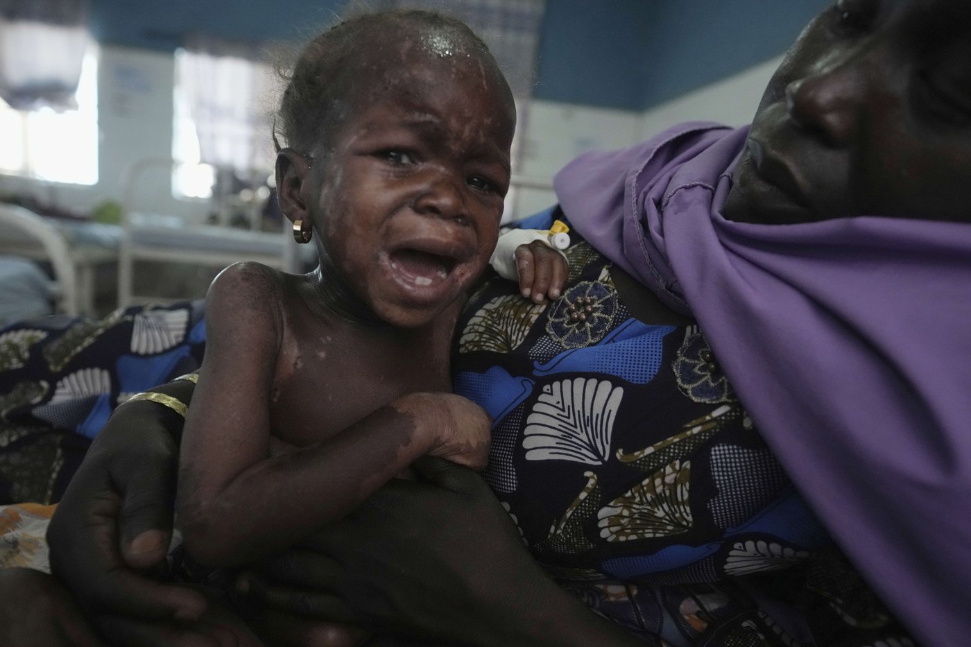 Children die as USAID aid cuts snap a lifeline for the world's most malnourished | iNFOnews.ca