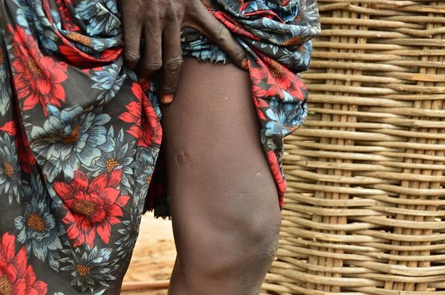 World moves closer to eradicating Guinea worm disease | iNFOnews.ca