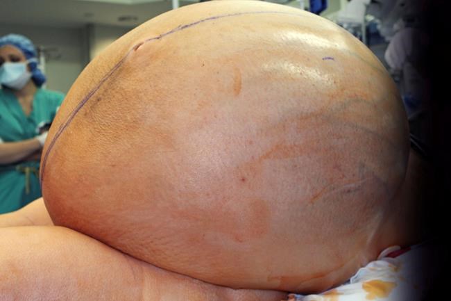 132-pound tumour removed from woman's abdomen | iNFOnews.ca CP870309023