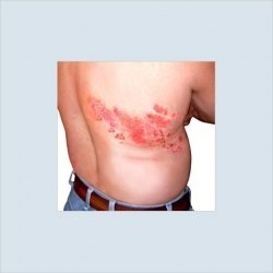 'Debilitating' pain can last months, years after shingles rash fades: experts | iNFOnews.ca CP19680407