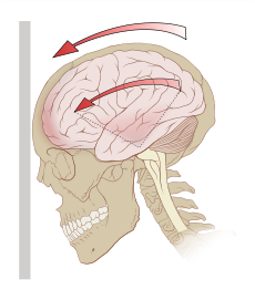 In new guideline, neurologists say experts should evaluate athletes with suspected concussions | iNFOnews.ca