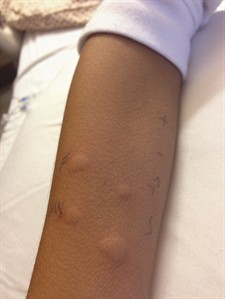 Report examines how boy got food allergies from blood transfusions | iNFOnews.ca