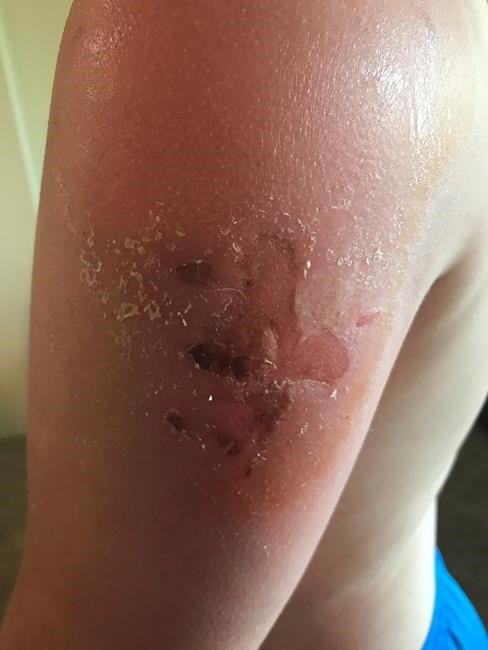 Health Canada testing Banana Boat sunscreen products as complaints mount | iNFOnews.ca