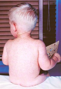 Why are Canadian measles outbreaks so much larger than U.S. outbreaks? | iNFOnews.ca Why are Canadian measles outbreaks so much larger than U.S. outbreaks? | iNFOnews.ca