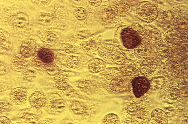 Gonorrhea, other STIs on rise in Canada; social media networks one possible reason | iNFOnews.ca Gonorrhea, other STIs on rise in Canada; social media networks one possible reason | iNFOnews.ca