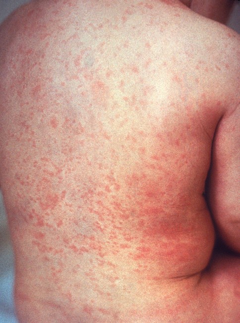 Americas has eliminated rubella, virus that can cause congenital defects | iNFOnews.ca Americas has eliminated rubella, virus that can cause congenital defects | iNFOnews.ca