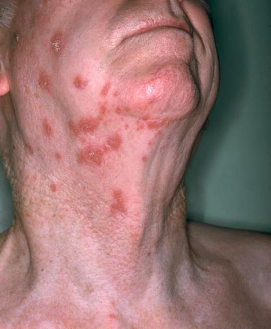 Doctors encourage inoculation against painful shingles, laud new vaccine | iNFOnews.ca