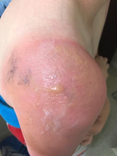 Some kids may be sensitive or allergic to certain sunscreen ingredients: doctors | iNFOnews.ca Some kids may be sensitive or allergic to certain sunscreen ingredients: doctors | iNFOnews.ca