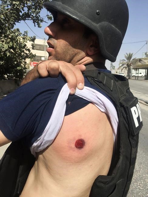 AP photographer wounded by Israeli fire while covering clash | iNFOnews.ca