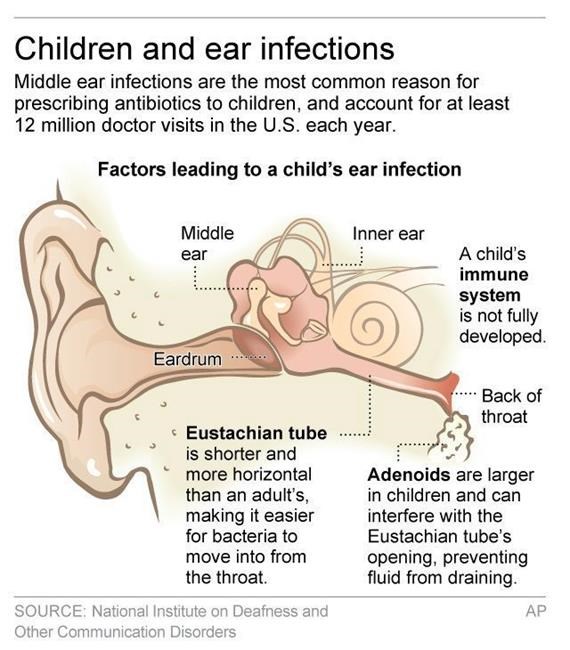 Researchers creating antibiotic gel to tackle ear infections | iNFOnews.ca