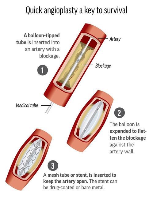 US hospitals set record for fast heart attack care | iNFOnews.ca