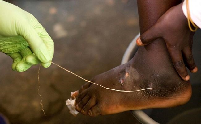 Guinea worm closer to eradication as cases halve in a year | iNFOnews.ca