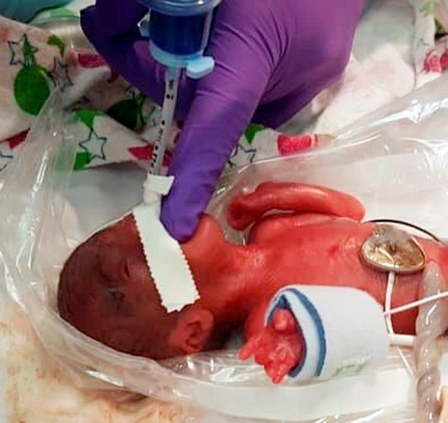 Girl believed to be tiniest newborn weighed as much as apple | iNFOnews.ca Girl believed to be tiniest newborn weighed as much as apple | iNFOnews.ca