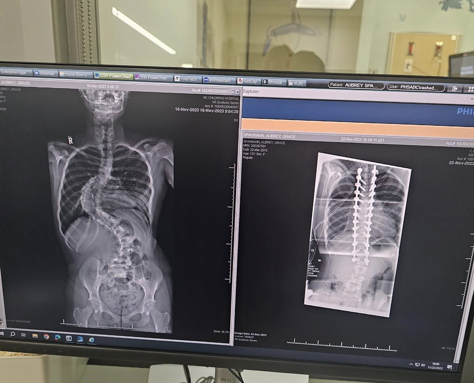 Kamloops teen three inches taller following risky spinal surgery for scoliosis | iNFOnews.ca