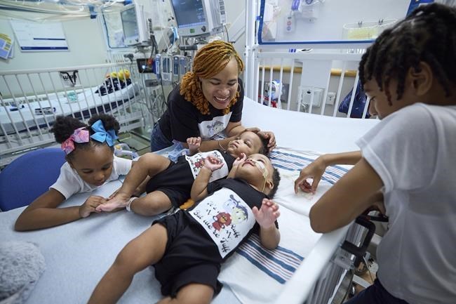 Twin boys born conjoined celebrate 1st birthday after separation surgery | iNFOnews.ca