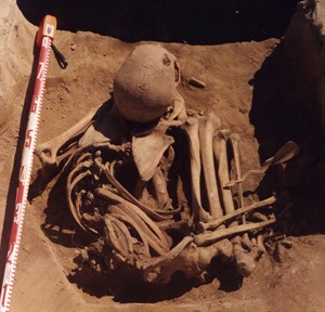Saskatchewan scientist finds ancient cancer in man who died 4,500 years ago | iNFOnews.ca Saskatchewan scientist finds ancient cancer in man who died 4,500 years ago | iNFOnews.ca
