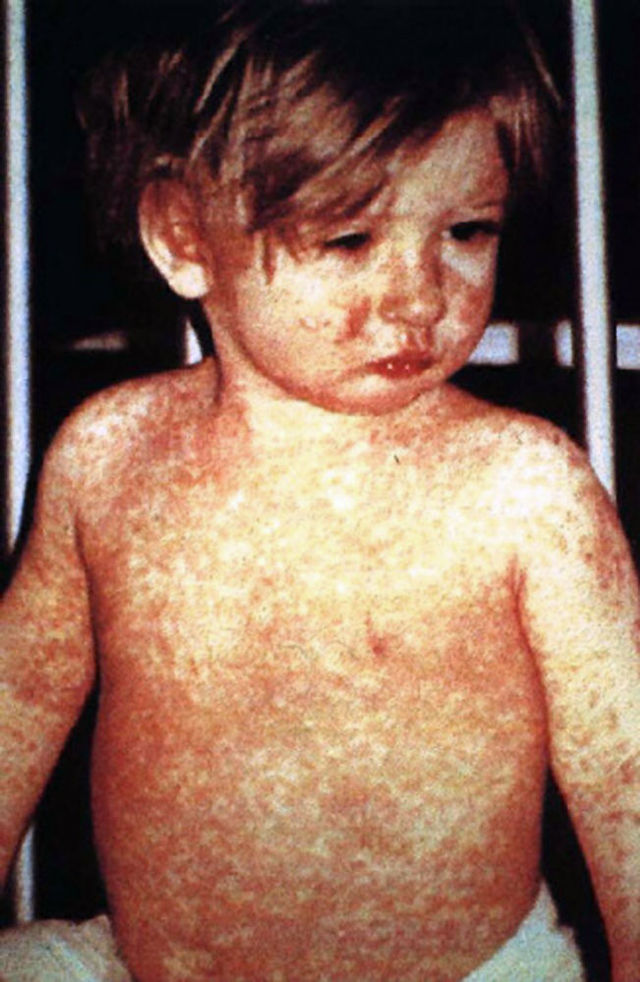 Canadian doctor recalls toll measles took on kids before MMR vaccine | iNFOnews.ca Canadian doctor recalls toll measles took on kids before MMR vaccine | iNFOnews.ca