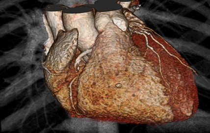 Study questions heart imaging; CT scans and older tests prove equally effective for chest pain | iNFOnews.ca