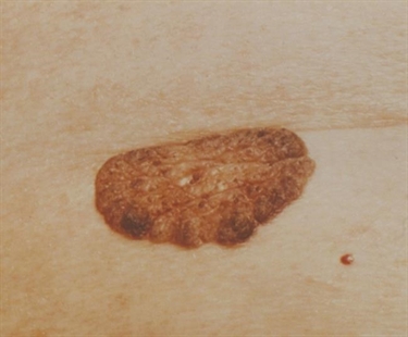 Sun spots, age spots: Is there anything you can do to stop brown skin patches? | iNFOnews.ca